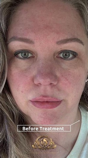 That eyebrow tattoo doesn’t match you anymore? Let’s fix it with Picofy Laser