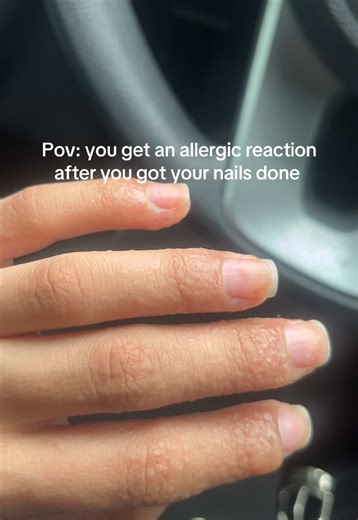 I got my nails done one day and my fingers got really itchy 😩 turns out I had an allergic reaction. If you have tips or tricks please help 😭 #allergicreaction #nails #fingers #itchy #fyp