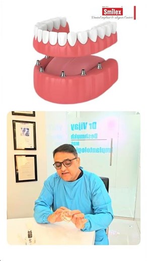 Confused Between All-on-4 or All-on-6? Best Dentist in Pune Explains the Truth