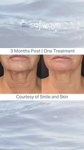 One treatment, remarkable lift. ✨ This incredible neck transformation highlights the power of our innovative SUPERB™️ ultrasound technology—clinically proven to stimulate collagen, elastin, and hyaluronic acid for visibly improved skin laxity. Confident results, naturally. | Sofwave