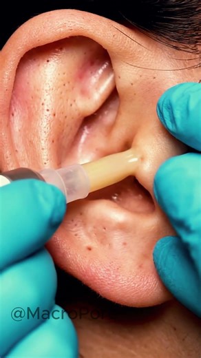 THIS EAR BLACKHEAD HAD PRESSURE 💥 #blackheadasmr