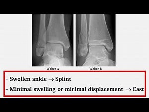 Ankle Fractures: Implications for stability and treatment