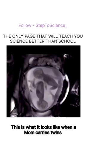 StepToScience on Instagram: "🤰✨ Twin Pregnancy Signs & Facts ✨🤰 A pregnant mother carrying twins often experiences a larger and faster-growing baby bump 🤍, along with stronger physical symptoms such as severe morning sickness 🤢, extreme fatigue 😴, and higher-than-average weight gain ⚖️. There is also a greater chance of early delivery ⏰ and a higher likelihood of Cesarean (C-section) delivery 🏥 compared to a single-baby pregnancy. 🔍 While these signs may suggest twins, only an ultrasound 