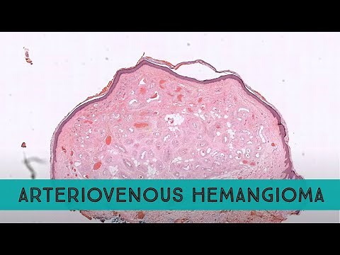 "Arteriovenous" Hemangioma (pathology dermpath dermatology dermatopathology)