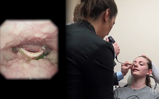 FEES Swallowing Study： Fiberoptic Endoscopic Evaluation of a Swallowing