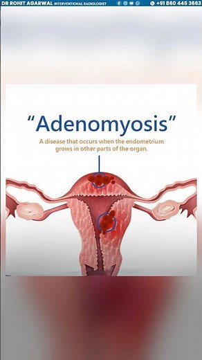 Stop Heavy Bleeding | Uterus Fibroids Treatment Without Surgery #nosurgery