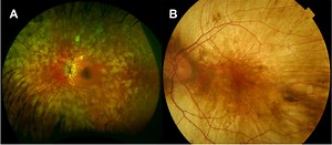Choroideremia: for professionals - Gene Vision