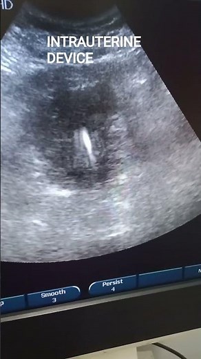 ULTRASOUND: INTRAUTERINE DEVICE IUD / IUCD #obstetricsandgynecology #contraception #ultrasound
