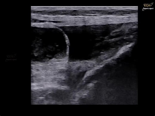 3 yrs old child 🚸 this free fluid indicating.....? #ultrasoundscan #radiology #medical #pregnancy #sonologist #sonography #ultrasoundstudio #ultrasoundtech #doctor #nurses #hospital #pediatrics | Ultrasound report expert