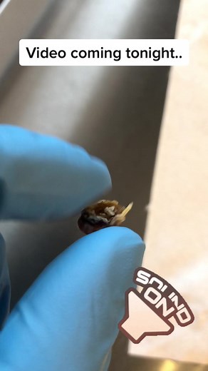 #ear #earwax #earwaxremoval #earwaxcleaning #earwaximpaction #audiologist #thewaxwhisperer