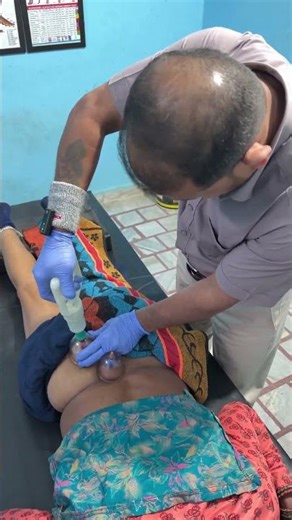 Sciatica is being treated cupping therapy