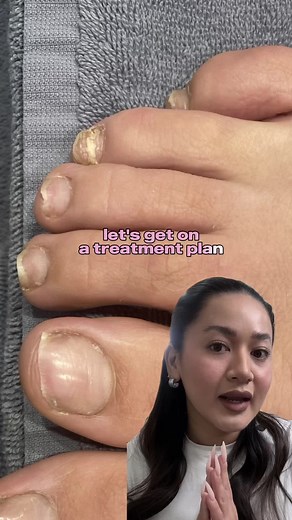 Effective Toe Fungus Treatment and Care Plan