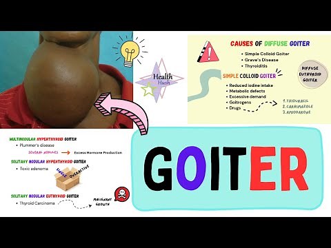 Goiter Simplified: Causes, Symptoms, and Types Explained