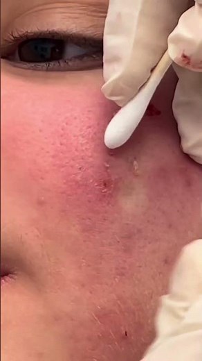 Multiple Blackhead Extraction