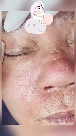 pimplepoppersatisfying su TikTok