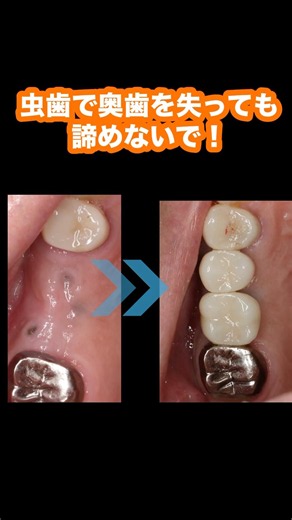 Dental Implant Treatment for a 65-Year-Old Male Before/After #Dentist #Implant #BackTooth