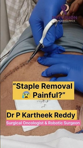 Stapler Removal After Surgery | Painful or Not? Surgical Staples Removal Explained