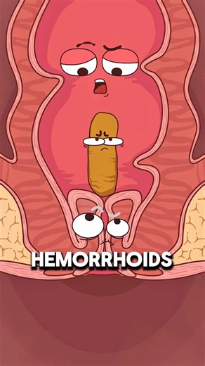 Why Chronic Constipation Can Cause Rectal Prolapse 🚽⚠️..!!#e2dhealth #animation #2dshow #fypシ