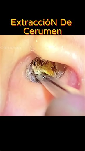 #extraccion #limpiar #cerume #diy #fyp