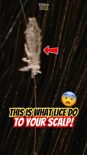 This is what lice do to your scalp⁉️😨 #lice #biology