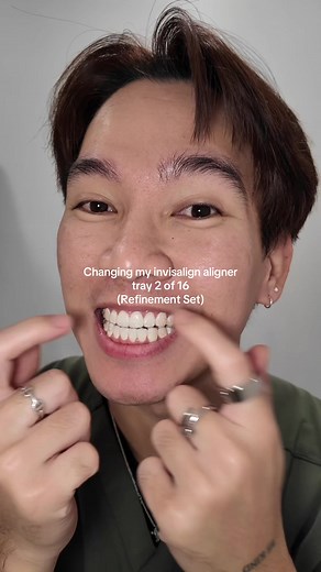 Invisalign Journey: Refinement Set Aligner 2 of 16