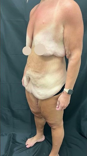 Skin Removal Plastic Surgery after massive weight loss