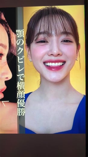 顎のクビレ: 美人の特徴や整形方法について