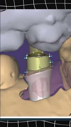 🦷 Implant placement in the jaw using Exocad 3.3 ⚡️#exocad