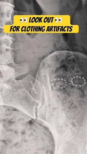 Clothing Artifacts on X-Ray