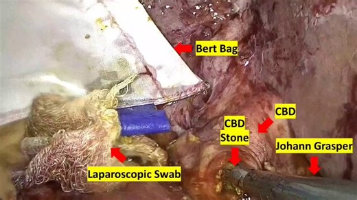 Tips for Retrieval of CBD Stone during Transcholedochal LCBDE🔴CBD >8mm🔴Atraumatic graspers useful🔴"Milking" CBDS🔴5mm choledochoscope with 0-Tip basket➡️Gentle "to-and-fro" motion ➡️Irrigation🔴Withdraw choledochoscope over basket wire with trapped CBDS🔴Extend choledochotomy#FOAMed #GITwitter #Surgery #SoMe4Surgery #HPB