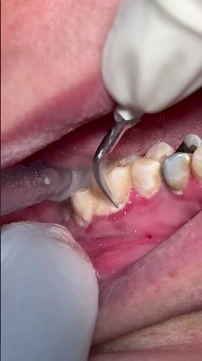 Scaling teeth from tartar and calculus #dental #satisfying