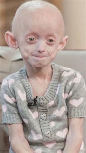 Hutchinson gilford progeria syndrome #shorts #education #nursing #rare