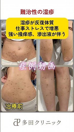 【難治性の慢性湿疹も、原因を総合的に考えることが大切です】