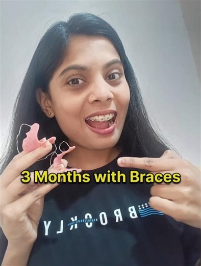 90 Days Difference! 😱 Braces Before & After #braces #bracesjourney #vlog
