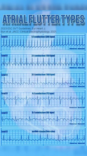 Atrial Flutter : Conduction & Ventricular Response Atrial flutter is a macro-reentrant atrial tachycardia with a characteristic sawtooth pattern on ECG, most visible in leads II, III, and aVF. The atrial rate is typically regular and ranges from 250-350 bpm. The ventricular response is determined by the refractory period of the atrioventricular (AV) node, leading to fixed conduction ratios. 🔹 2:1 Block: Most common; ventricular rate ~150 bpm 🔹4:1 Block: Target with pharmacologic rate control �