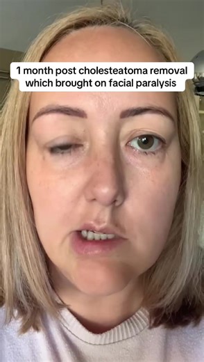 Sort of a bit of progress in my facial paralysis I suffered after cholesteatoma surgery. This video was taken a month after surgery. I’m posting old videos to help people know what to expect. #cholesteatoma #mastoidectomy #facialparalysis #facialnerve #facialpalsy