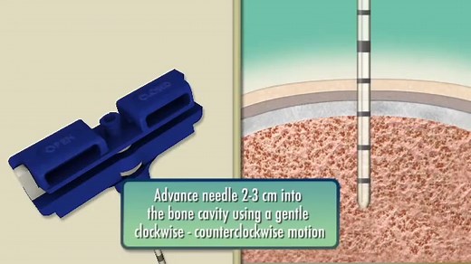 SNARECOIL™ Bone Marrow Biopsy Needle