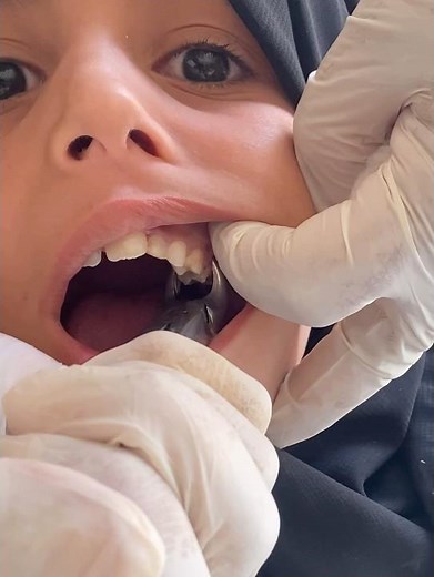 خلع ضرس 🦷 بجذرين مدببة
