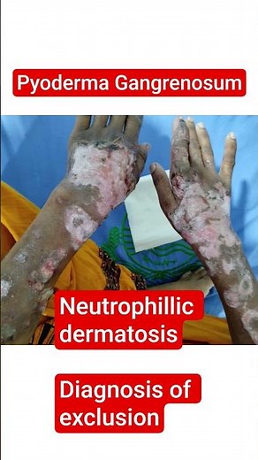 Pyoderma Gangrenosum #ulcer #blisters #hand #dermatology #neutrophils #skincare