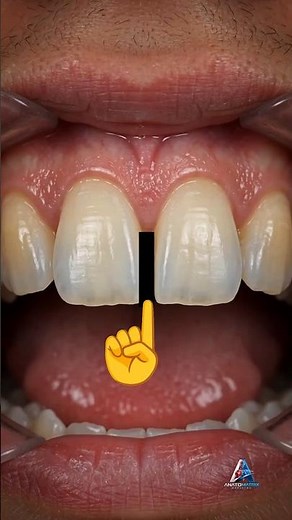 Satisfying Tooth Gap Restoration 🦷 | How Dentists Fix Tooth Gaps Without Braces