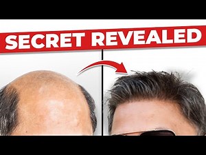 Natural Hairline Secret Revealed &vert | Hair Fixing Transformation