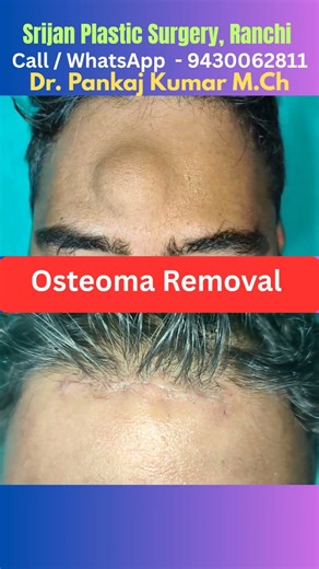 Scarless Osteoma Removal surgery| Best osteoma Removal surgery in India #osteoma