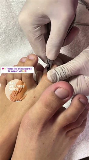 🌼 Gentle Care for Swollen Toenails — Your Toes Will Thank You! 🦶💗#nails