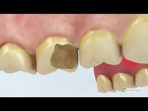 Video Tutorial: Dental Crowns Procedure