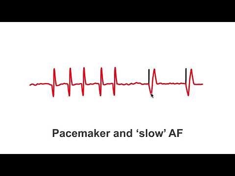 Pacemakers and 'slow' AF patients