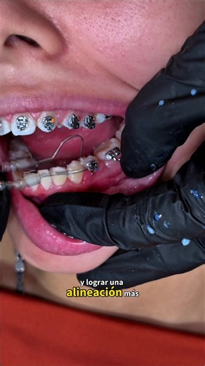 Caso de Ortodoncia Complejo: ¿Qué se Resuelve con Brackets?