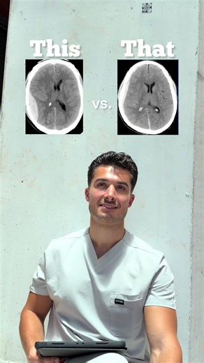 Neuro Rapid Fire: This vs That 🧠🔥 Save this for your exams!! #medstudent #medschool #usmle #usmlestep1 #neurology