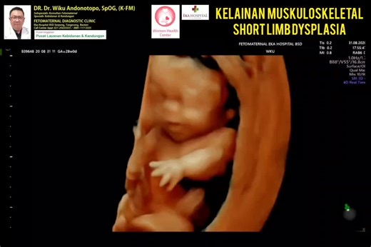 Understanding Achondroplasia: Causes, Symptoms, and Treatment Options