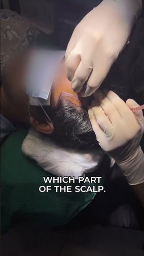 Thinking of a Hair Transplant? Watch This BEFORE You Do || Dr. Sarin ||