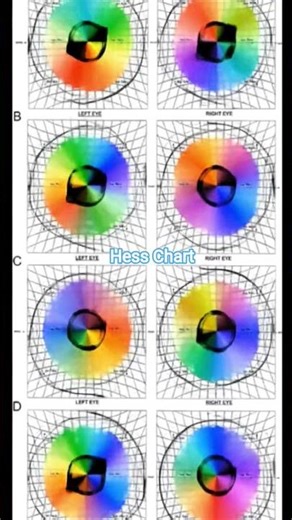 Hess Chart#eyes #double #vision #diplopia #paralysis #muscle #ug #pg #reels #shorts #facts #viral